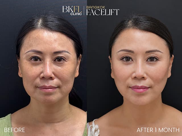 Female Facelift - Before and after result 2